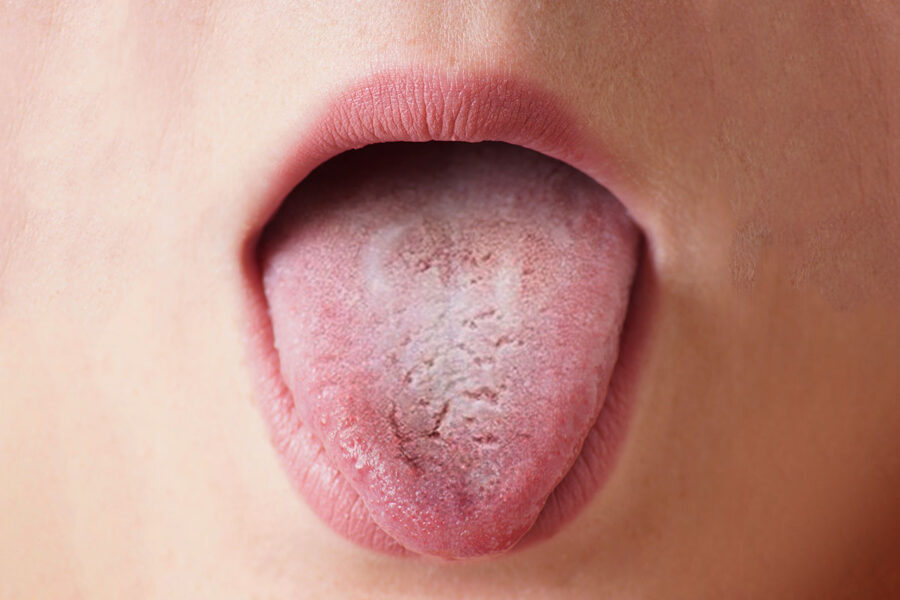 Cáncer de lengua - Dra. Irene Borro