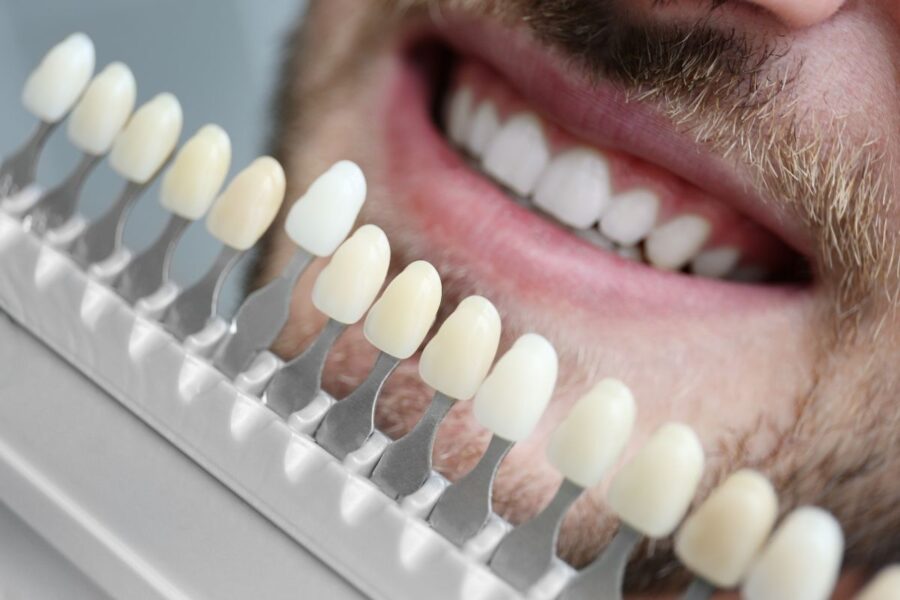 Carillas dentales de los famosos - Clínica Dental Dra. Borro