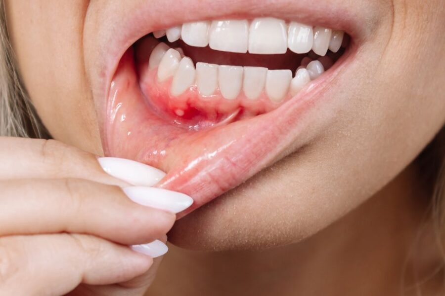 flemón dental