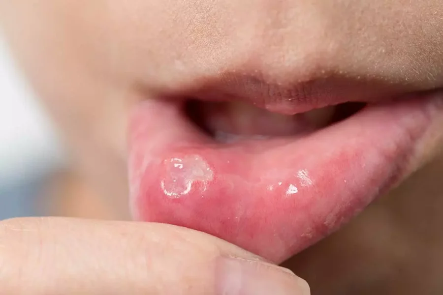Estomatitis