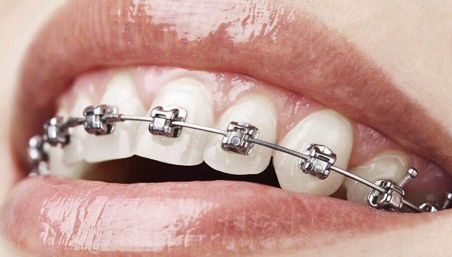 brackets autoligables