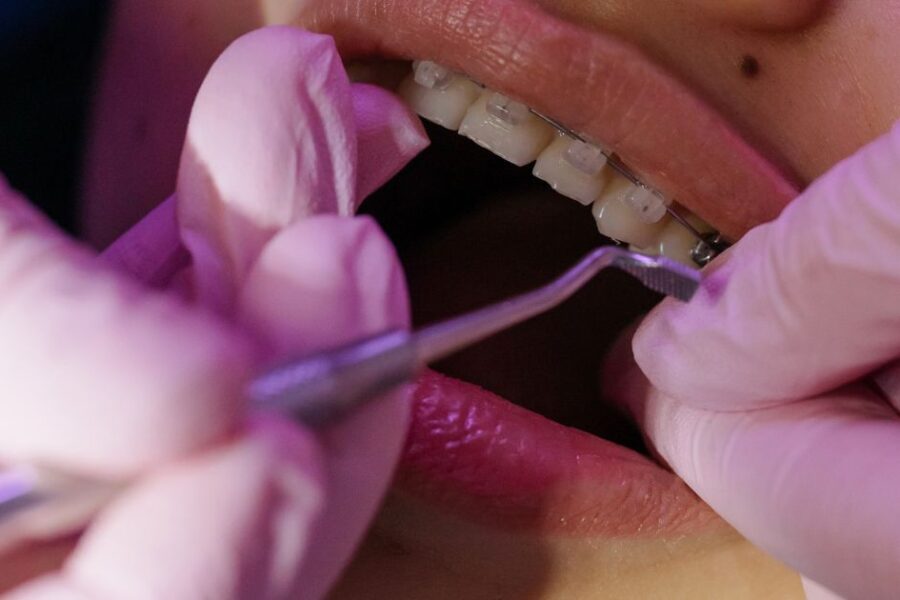 Fenestración dental