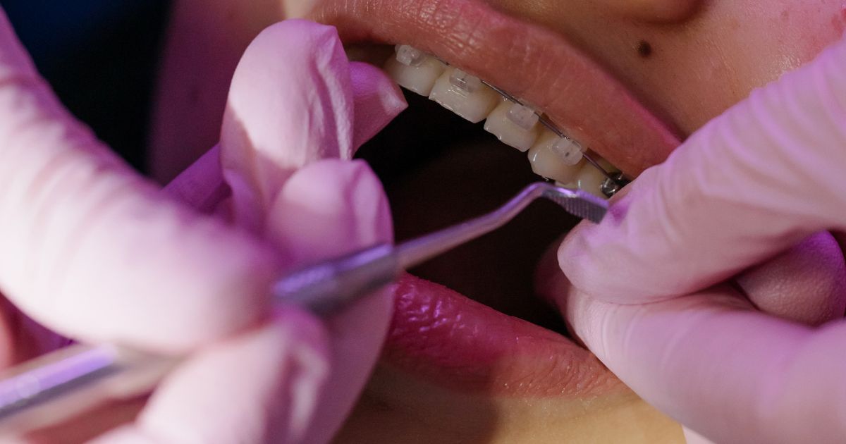 Fenestración dental