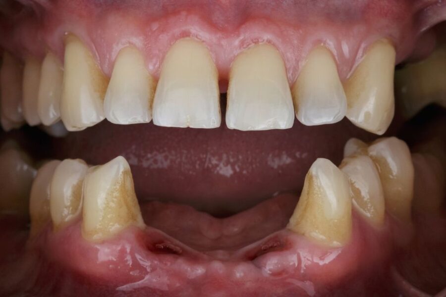 Agenesia dental