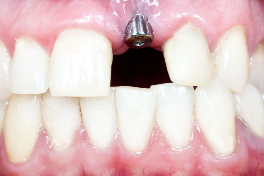 Mucositis