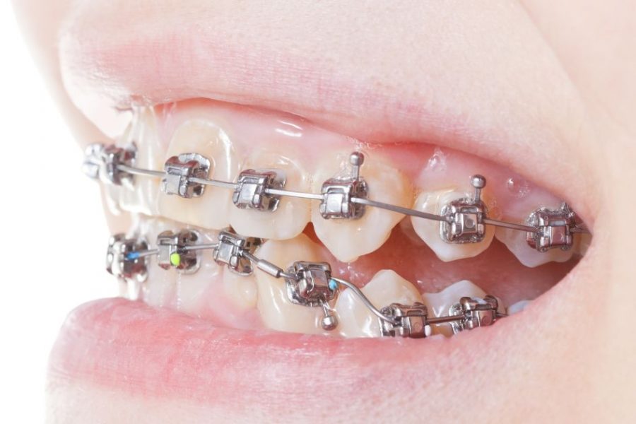Protrusión dental