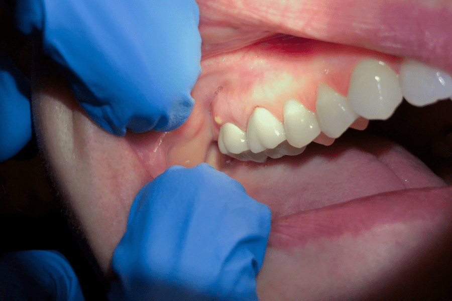 Absceso periodontal: Síntomas y tratamiento - Clínica Dental Dra. Borro