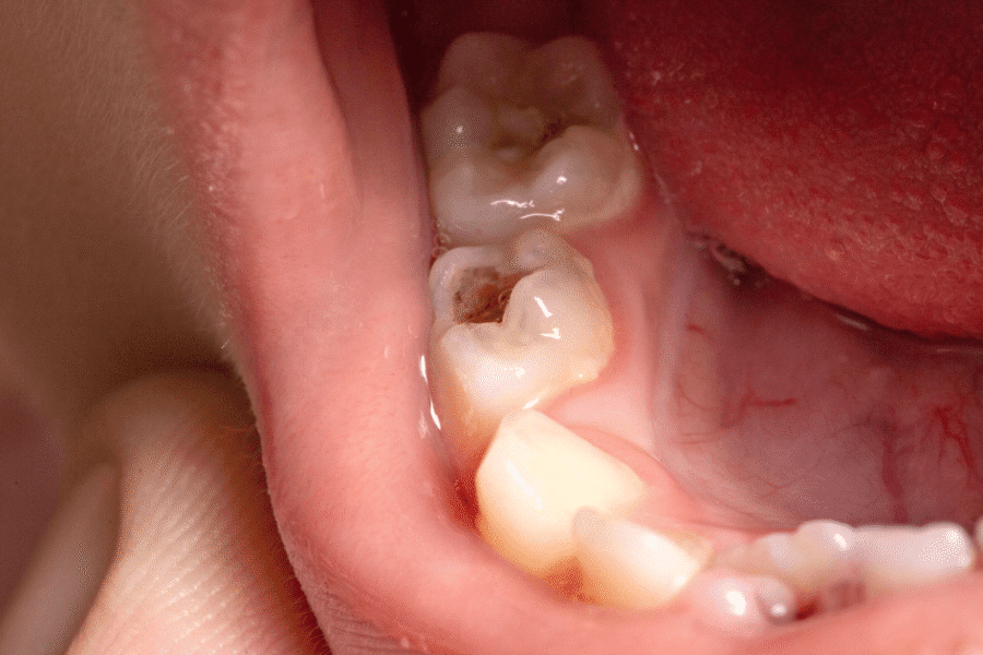 caries infantil