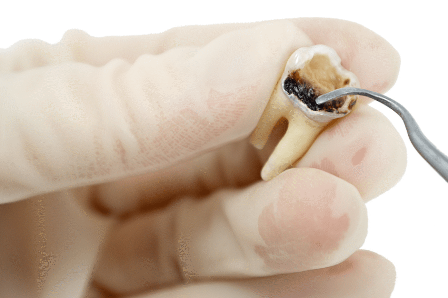 caries profunda