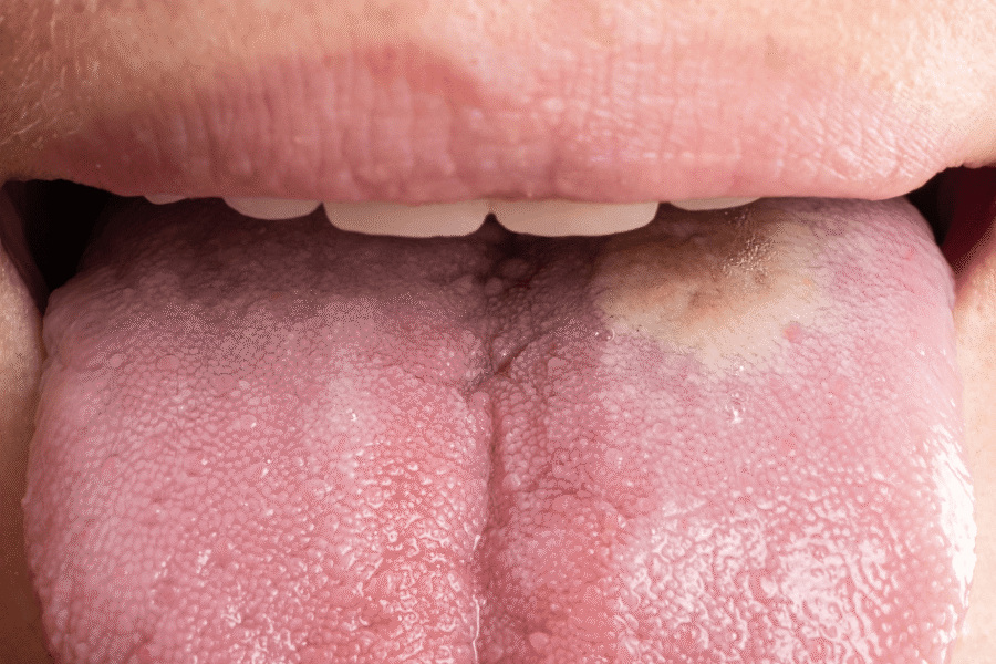 candidiasis en la boca