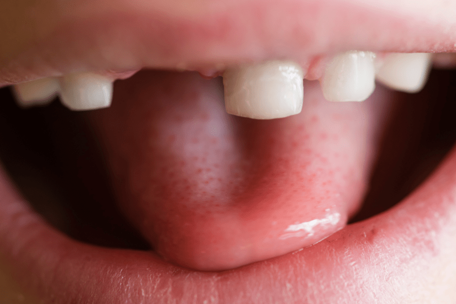 dentición mixta