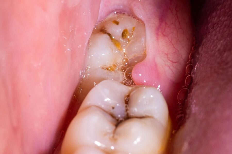 dientes includos