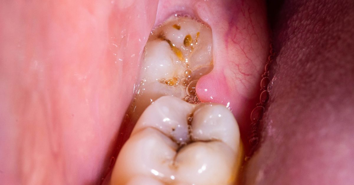 dientes includos