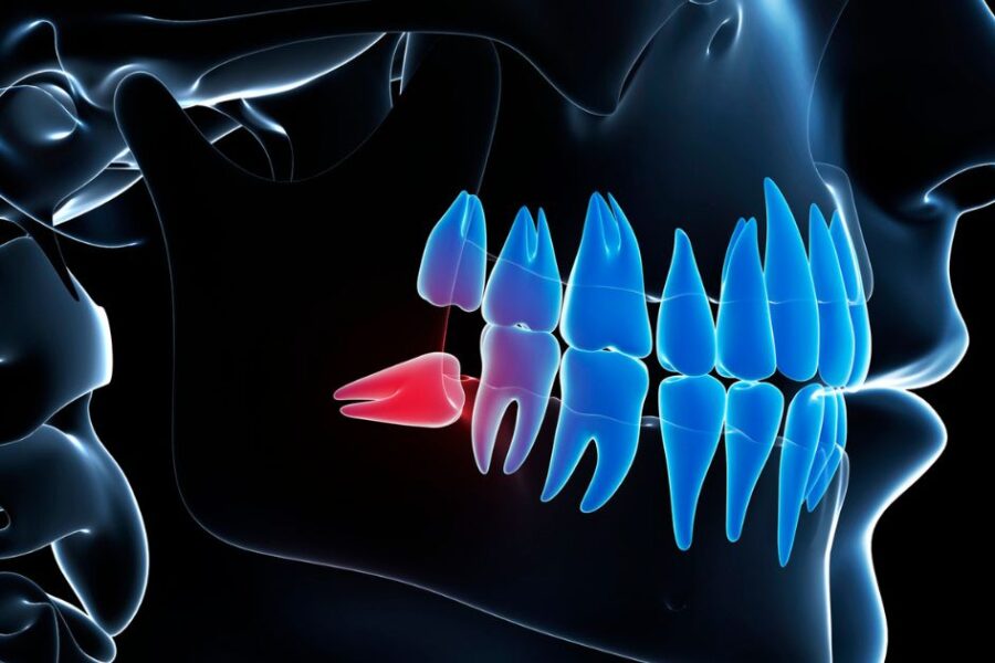 dientes retenidos