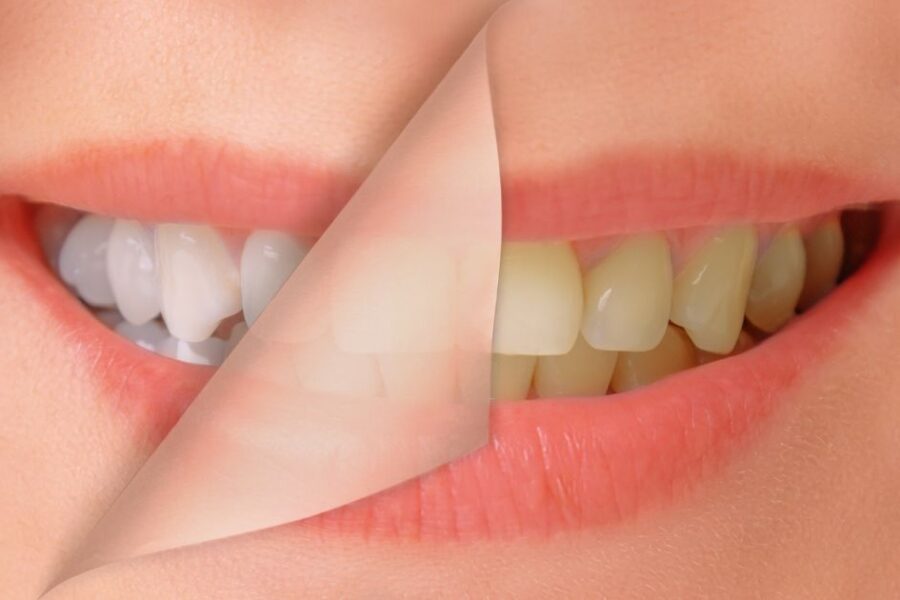 dientes amarillos