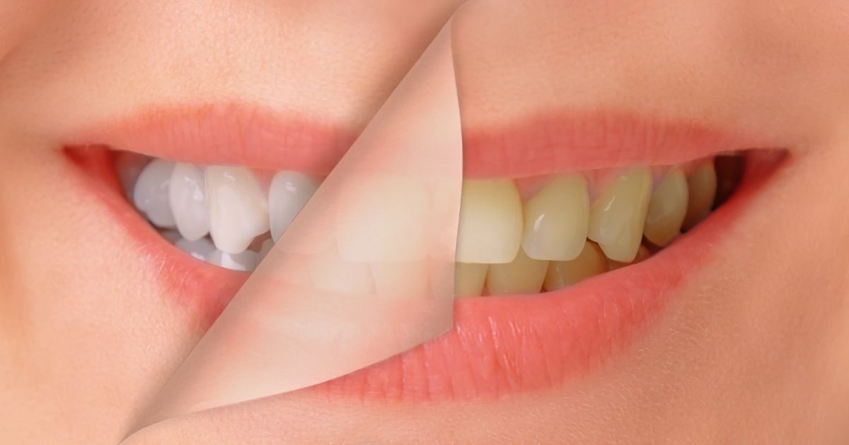 dientes amarillos