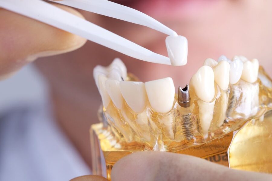 rechazo implante dental