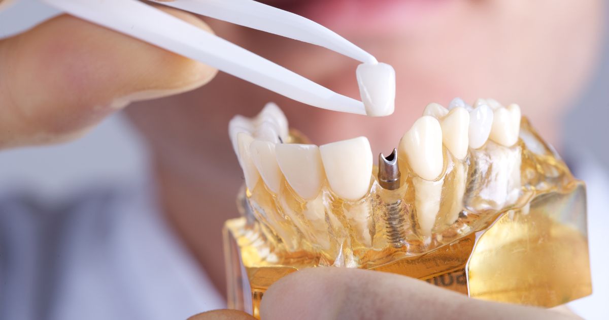 rechazo implante dental