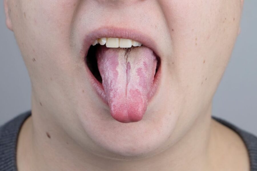 Lengua con hongos