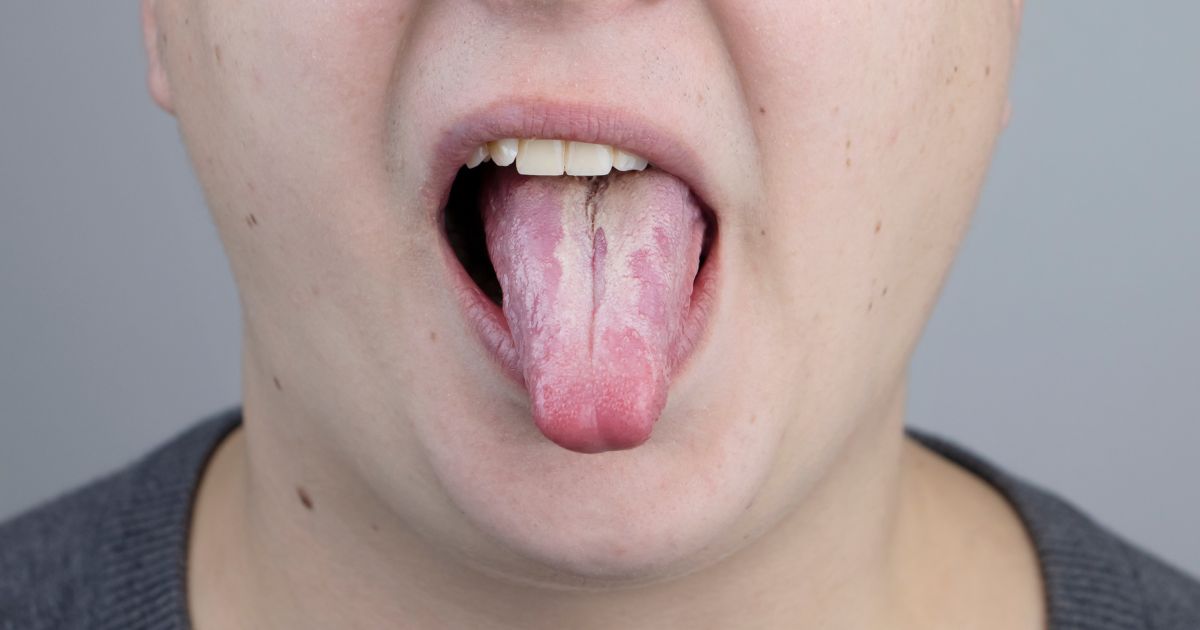 Lengua con hongos