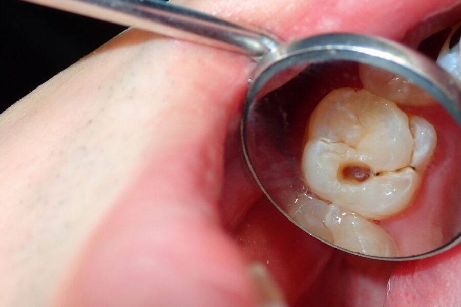 Muela con caries
