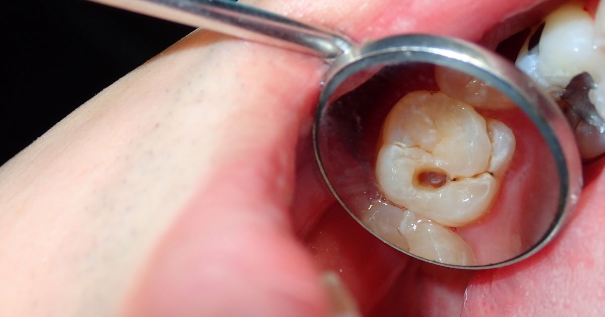 Muela con caries