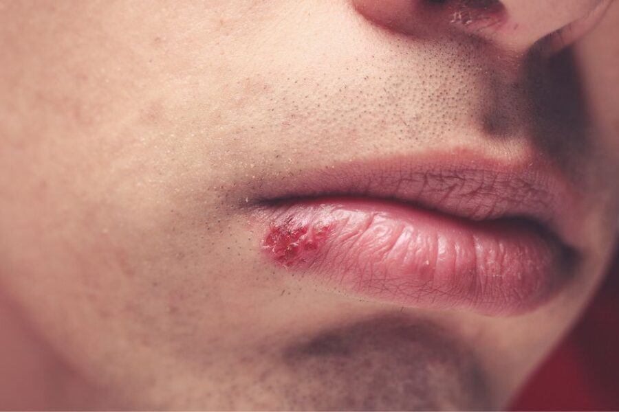 calentura labial
