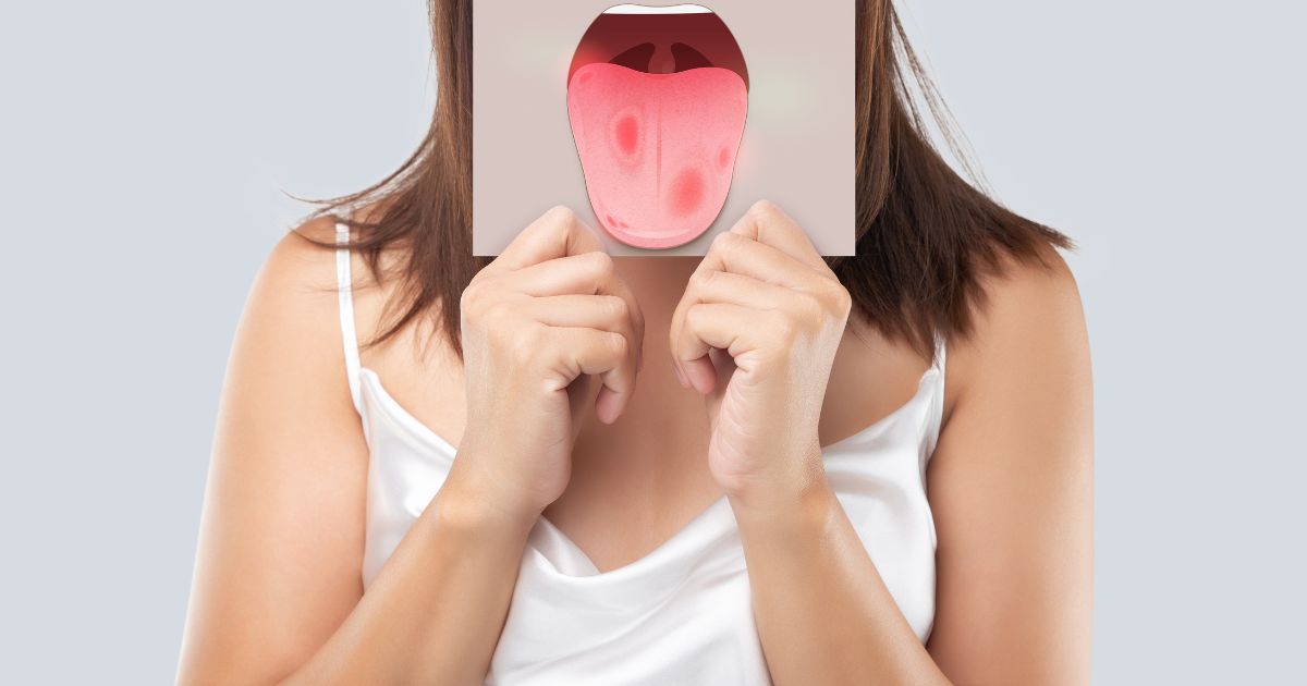 leucoplasia