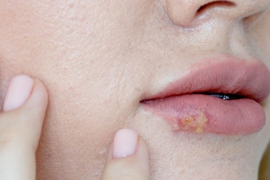granos en el labio