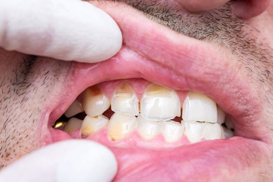 hipoplasia