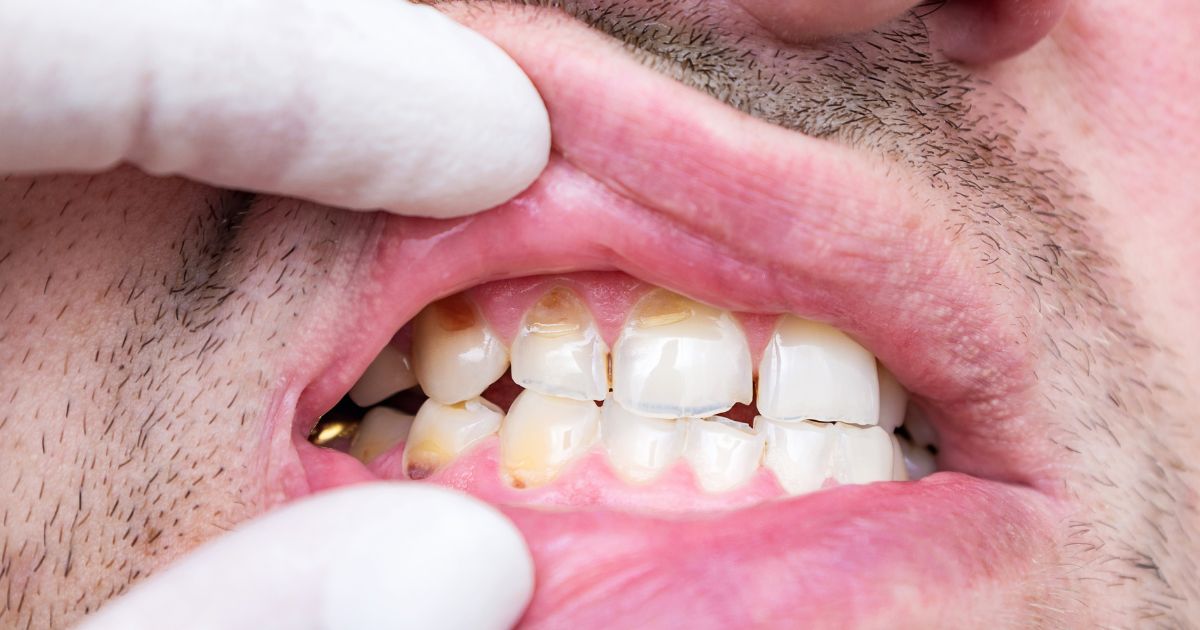 hipoplasia