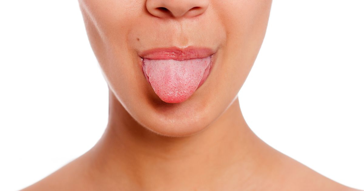 lengua amarilla