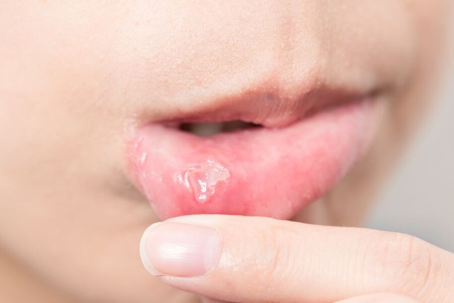 infección oral