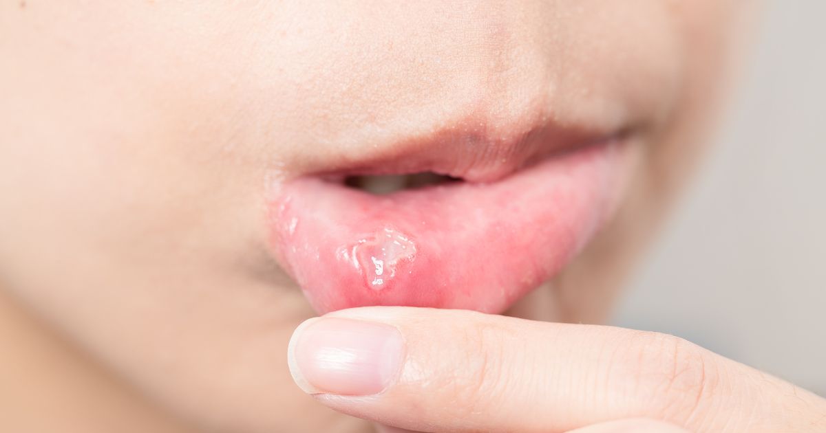 infección oral