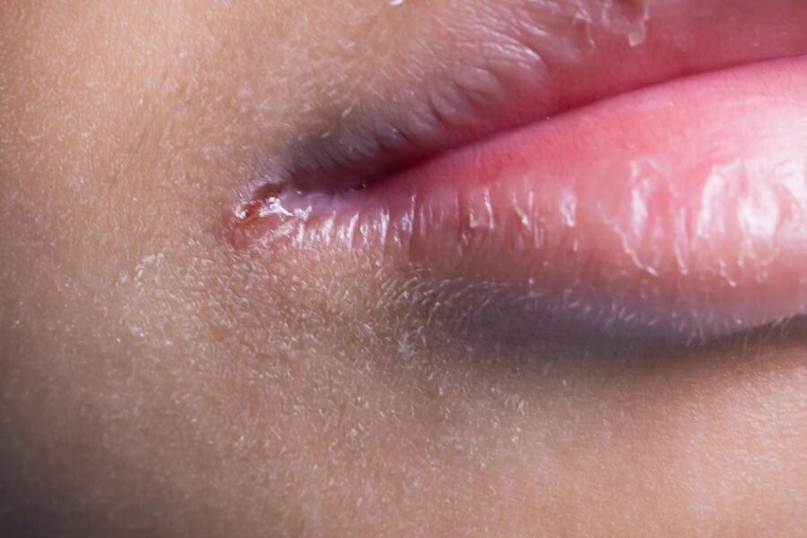 queilitis angular