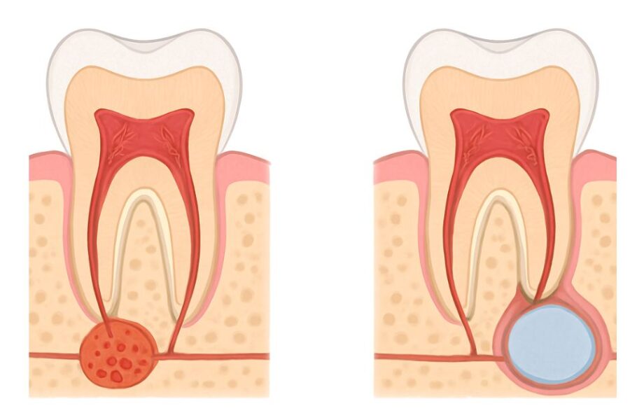granuloma periapical