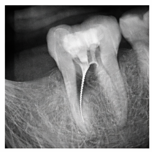 instrumento fracturado en endodoncia