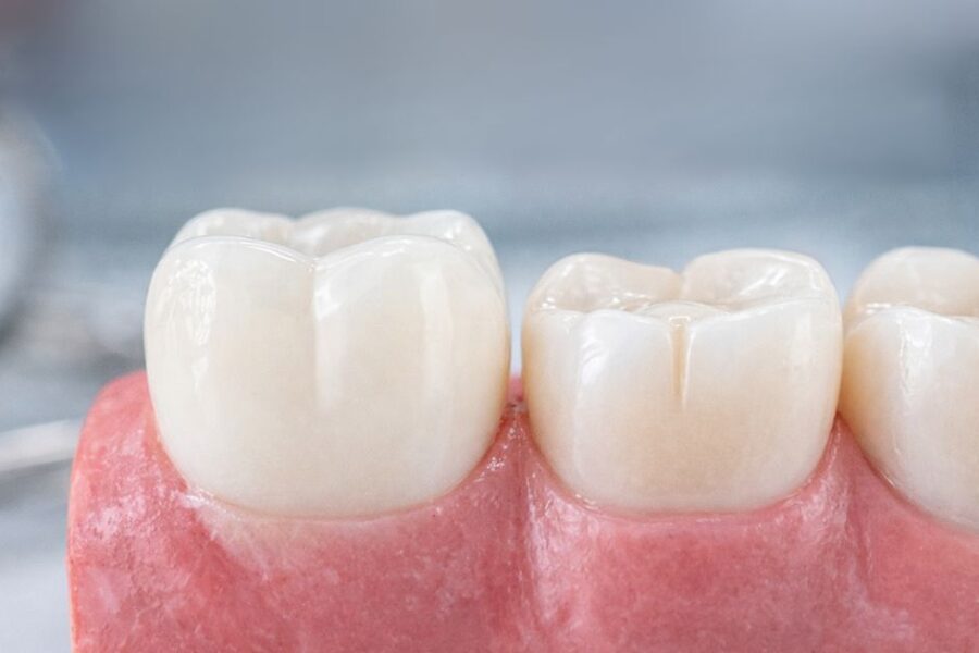 reconstrucción tras endodoncia