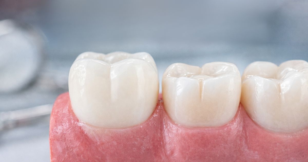 reconstrucción tras endodoncia
