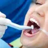 selladores dentales