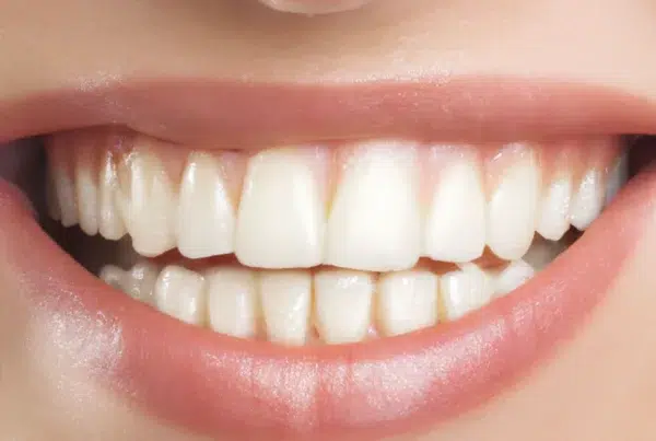 Recesión gingival: qué dice la evidencia sobre cuándo tratar y con qué técnica - Clínica Dental Dra. Borro recesión gingival