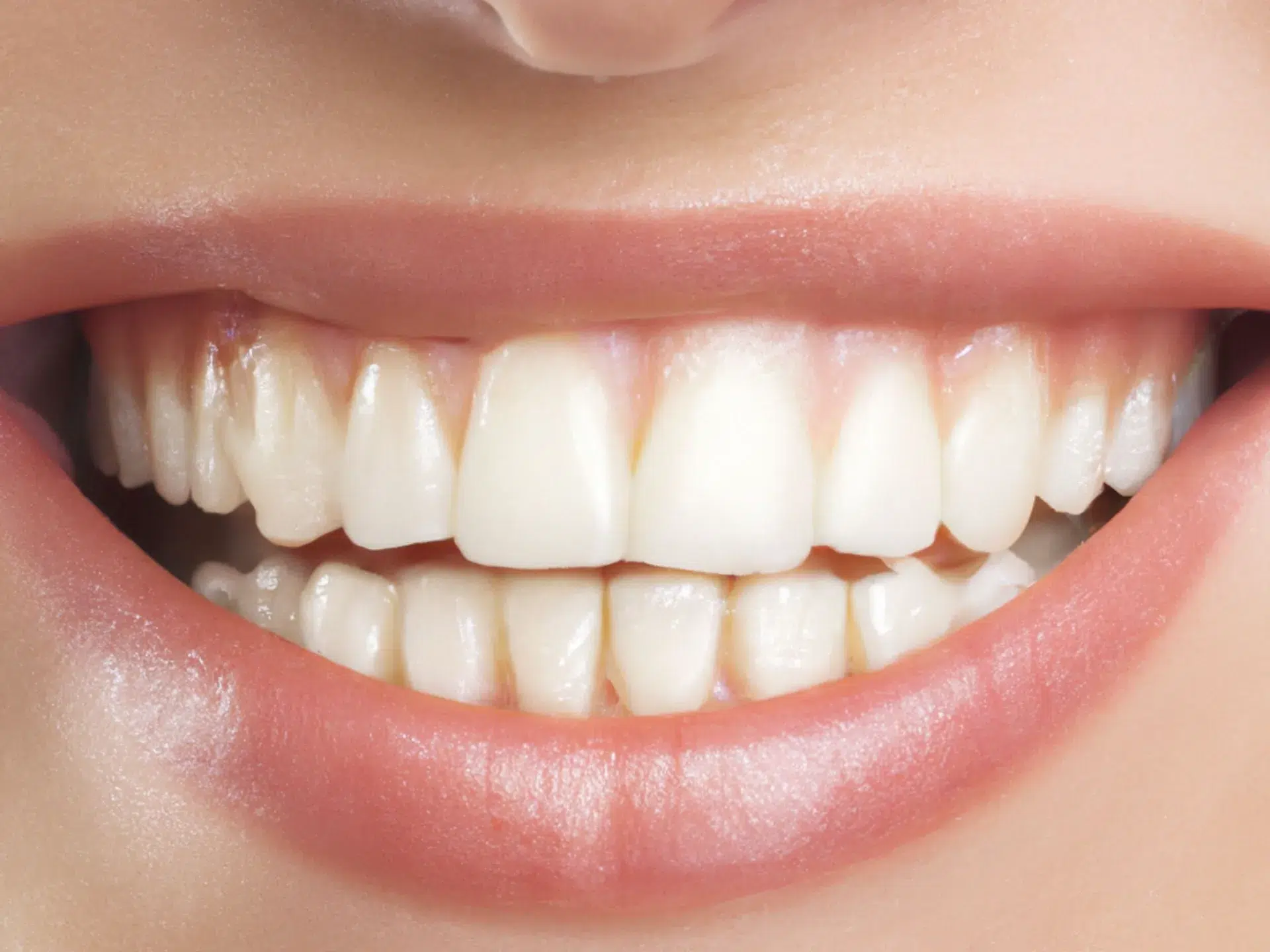 recesión gingival